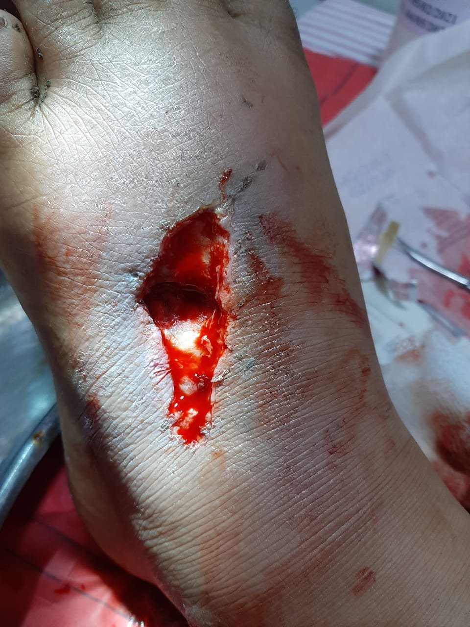 Before Surgery